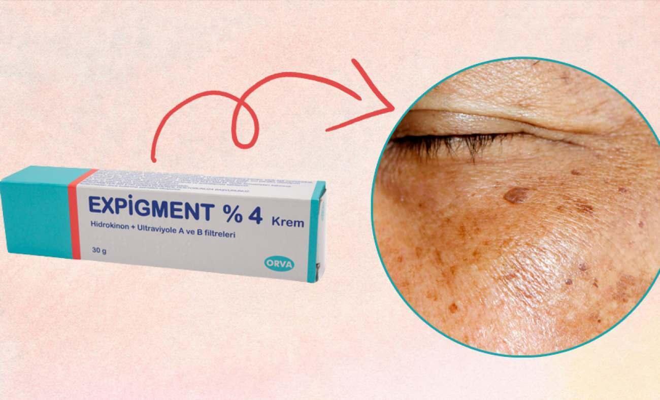 expigment krem ne ise yariyor expigment krem nasil kullanilir expigment krem fiyati 1644577457 963